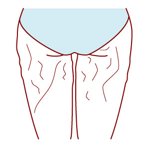 太ももの脂肪吸引で失敗すると皮膚の表面がボコボコに？
