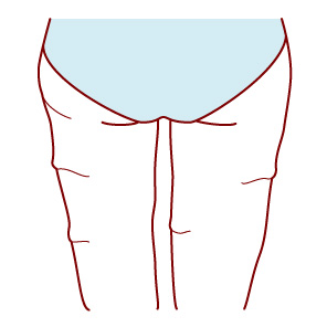 太ももの脂肪吸引で失敗すると皮膚のたるみができる？