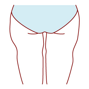 太ももの脂肪吸引で失敗すると不自然なラインになる？
