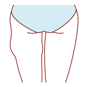 太ももの脂肪吸引で失敗すると左右のバランスが取れない？