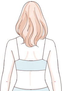 二の腕の脂肪吸引傷がつく位置・背面